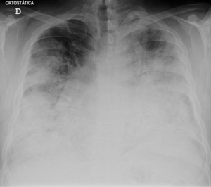 legionnaires' disease
