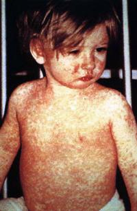 measles