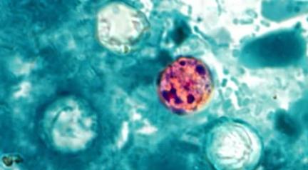 Cyclospora Outbreak Now Hits Nine US States