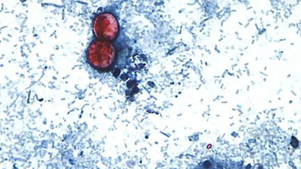Cyclospora Cases Top 11,500, New Outbreak Probed
