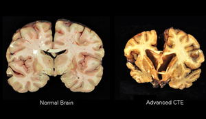 chronic traumatic encephalopathy