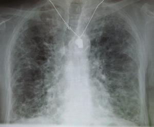 pulmonary fibrosis