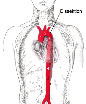 aortic dissection