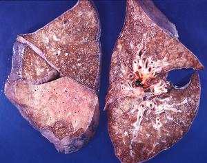pneumonia