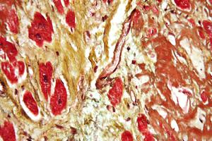 cardiovascular disease