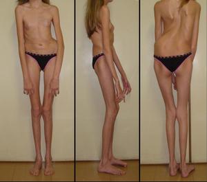 Marfan syndrome