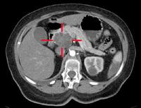pancreatic cancer