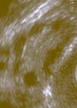 polycystic ovary syndrome