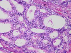 prostate cancer
