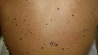 Doctors Warn Against Tanning Trend