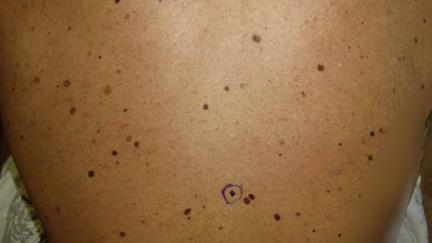 Doctors Warn Against Tanning Trend