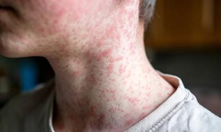 Pennsylvania reports first measles deaths in 35 years
