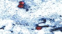 Cyclosporiasis Outbreak Linked to Lettuce