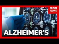 Alzheimer's Breakthrough Drugs Questioned